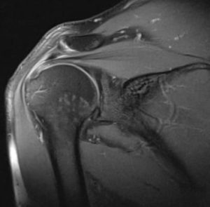 lesões no ombro e cotovelo