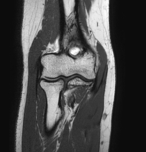 lesões no ombro e cotovelo
