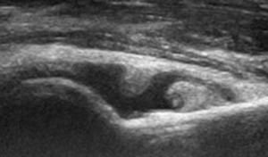 lesões no ombro e cotovelo