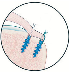 ancora-manguito-rotador-lesao-ombro-dor-joao-basmage-tratamento-cirurgia-campo-grande-ms